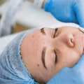 Exploring Acne Treatments at Skin Clinics: What You Need to Know