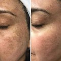 How a Skin Clinic Can Effectively Treat Dark Spots and Hyperpigmentation