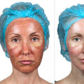 Understanding the Side Effects of Chemical Peels at Skin Clinics