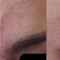 How Skin Clinics Can Effectively Address Scar Removal and Reduction