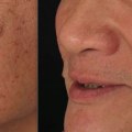 Exploring Skin Clinics: Treatments for Sun Damage and Sun Spots