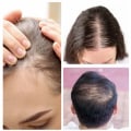 Exploring Hair Loss Treatments at Skin Clinics: What You Need to Know