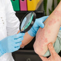 Exploring Psoriasis Treatments at Skin Clinics: What You Need to Know