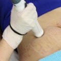 Exploring Stretch Mark Treatments at Skin Clinics