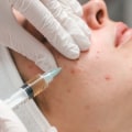 How Often Should You Visit a Skin Clinic for Effective Acne Treatment?