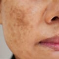 Understanding Melasma Treatment Options at Skin Clinics