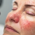 Exploring Rosacea Treatments at Skin Clinics: What You Need to Know