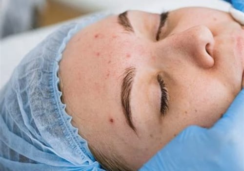 Exploring Acne Treatments at Skin Clinics: What You Need to Know