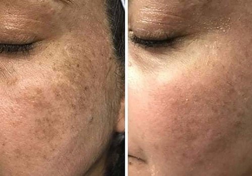 How a Skin Clinic Can Effectively Treat Dark Spots and Hyperpigmentation