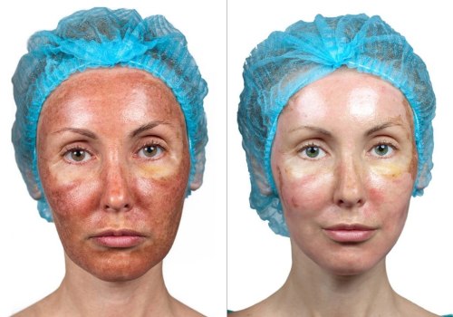 Understanding the Side Effects of Chemical Peels at Skin Clinics