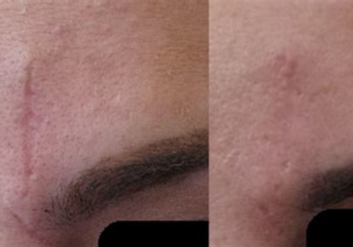 How Skin Clinics Can Effectively Address Scar Removal and Reduction