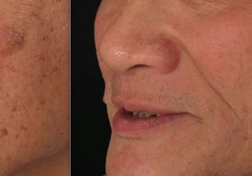 Exploring Skin Clinics: Treatments for Sun Damage and Sun Spots