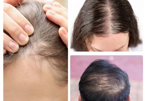 Exploring Hair Loss Treatments at Skin Clinics: What You Need to Know
