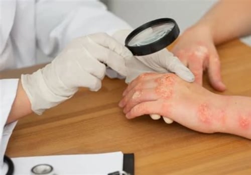 Exploring Fungal Infection Treatments at Skin Clinics