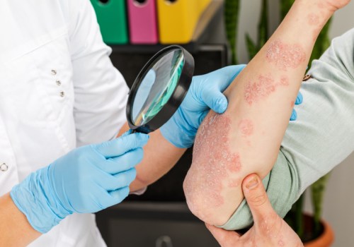 Exploring Psoriasis Treatments at Skin Clinics: What You Need to Know