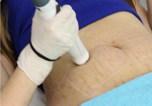 Exploring Stretch Mark Treatments at Skin Clinics