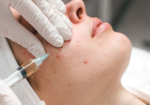 How Often Should You Visit a Skin Clinic for Effective Acne Treatment?