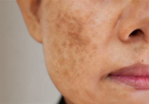 Understanding Melasma Treatment Options at Skin Clinics