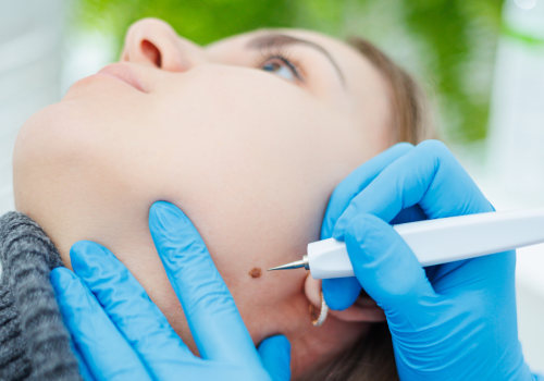 Understanding Mole Removal: The Role of Skin Clinics